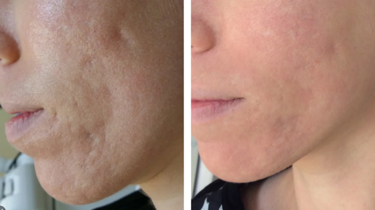 Laser Skin Resurfacing: The Non-Surgical Solution for Acne Scars